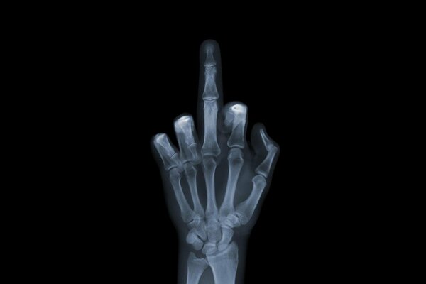 Hand mit Blick auf Knochen auf Röntgenaufnahmen